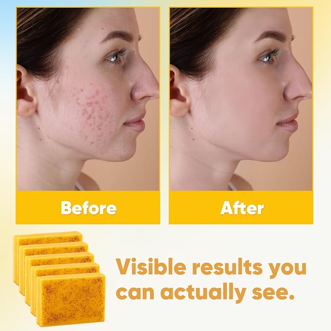 Treeroot 5 Pack Turmeric Soap, 80g Kojic Acid and Turmeric Soap Bar, Gently Clean the Face, Contains Retinol, Collagen, Vitamin C, Shea Butter, Used for Face & Body, SLS Free