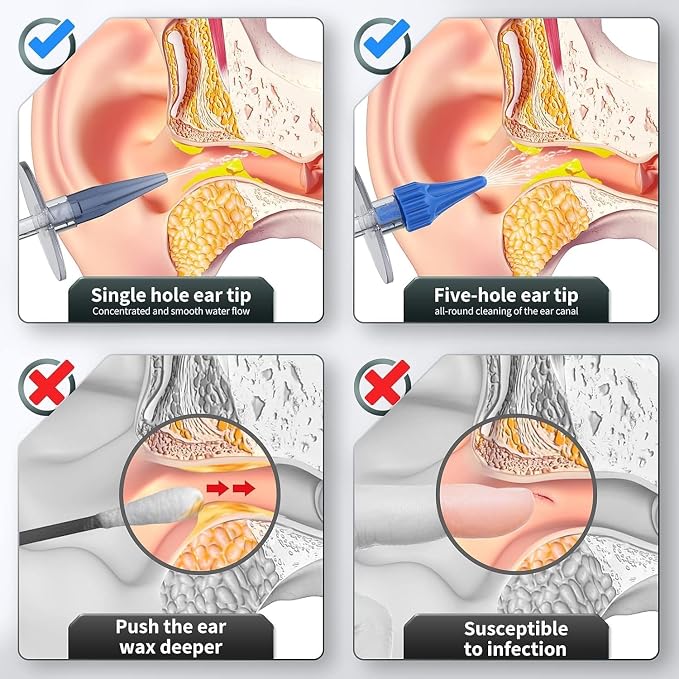 Ear Wax Removal, Ear Cleaner, Ear Cleaning Kit, Manual Ear Irrigation Flushing System, Ear Wax Removal Kit, Safe and Effective to Clean Ear Built Up Wax