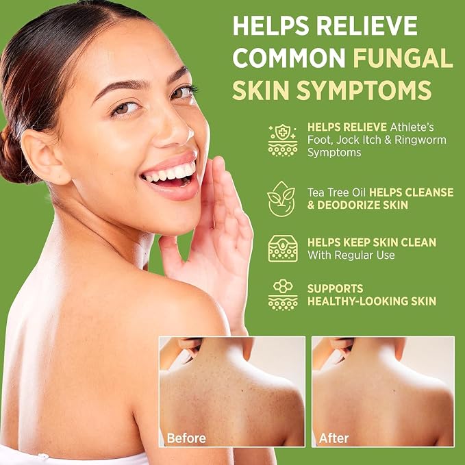 Roycederm Antifungal Bar Soap - Tea tree Oil Soap - Athlete’s Foot Treatment for Jock Itch & Ringworm - Medicated Antifungal Soap with Clotrimazole 1% - Tea Tree Oil Scent, 3 Pack