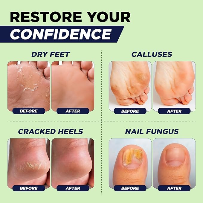 FOOT CURE Tea Tree Oil & Muscle Foot Soak with Epsom Salts - All-Natural Salts for Post-Workout Recovery - Softens Calluses, Soothes Sore & Tired Feet, Foot Odor Control, Spa Pedicure (Pack of 2)