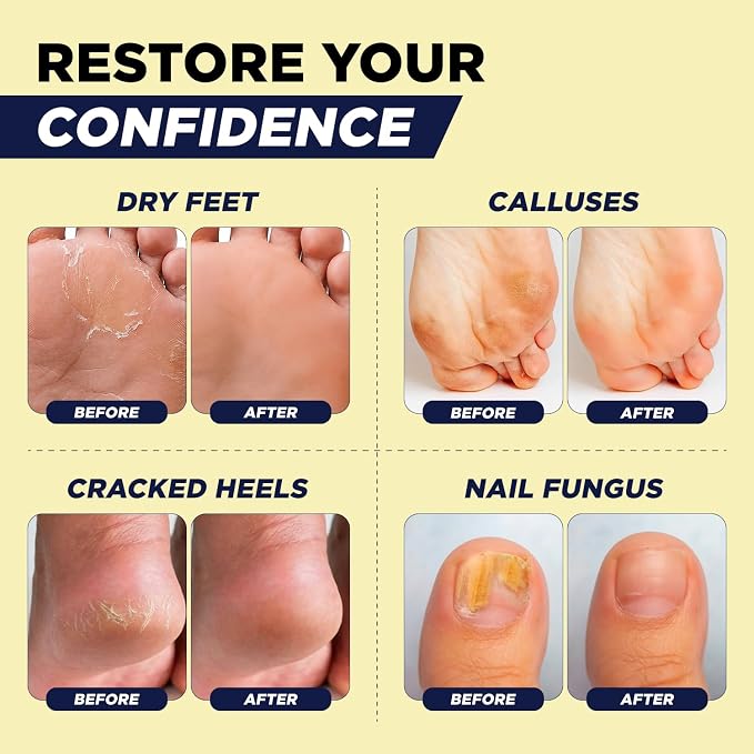 FOOT CURE Citrus Detox Foot Soak with Epsom Salts – for Foot Callus, DaMaged Toenail Appearance, Pedicure Spa, and Soothing Sore, Tired Feet - 16 oz (Pack of 1)