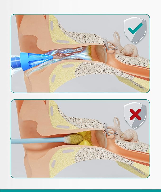 Medi Grade Ear Syringe Ear Wax Removal with 3 Quad-stream Tips - Water Irrigation Ear Cleaner Ear Wax Remover for Improved Hearing Clarity and Aural Hygiene - Ear Syringe Kit Earwax Remover Tool